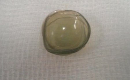 Surgeons find 27 contact lenses lodged in woman's eye