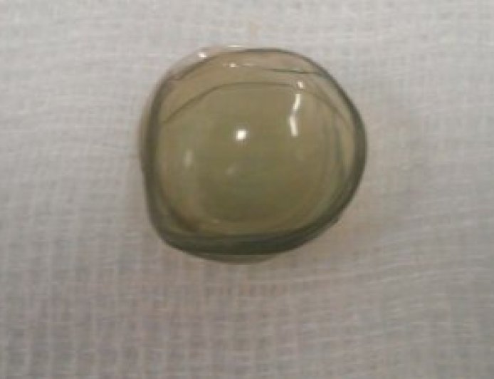 Surgeons find 27 contact lenses lodged in woman's eye