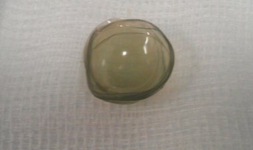 Surgeons find 27 contact lenses lodged in woman's eye