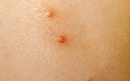 Explainer: Molluscum Contagiosum and Its Appearance in Epstein Case Records