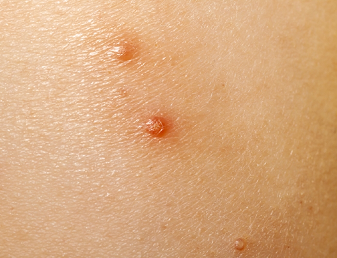 Explainer: Molluscum Contagiosum and Its Appearance in Epstein Case Records